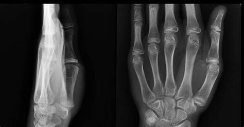 Torus Fracture Treatment | Torus Bone Fracture Types