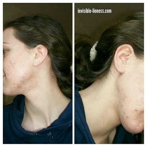 Being vulnerable: My painful struggle with hormonal acne