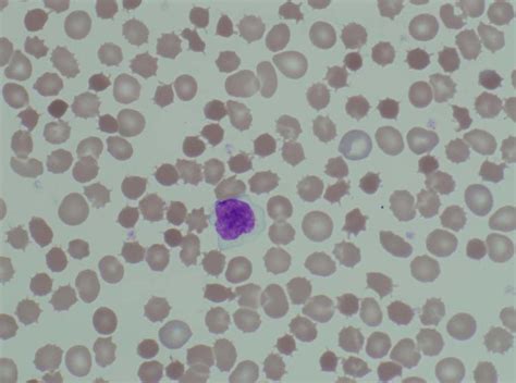 Acanthocytosis