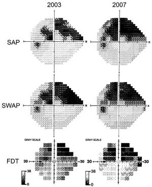 Glaucomatous visual field progression - American Academy of Ophthalmology