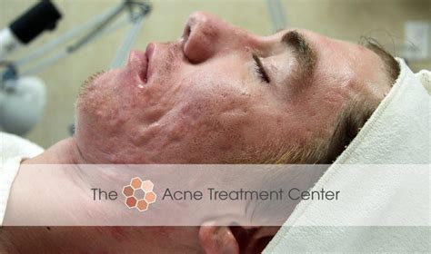 Conglobata Acne Treatment Photo | Acne Treatment Center | Portland OR ...