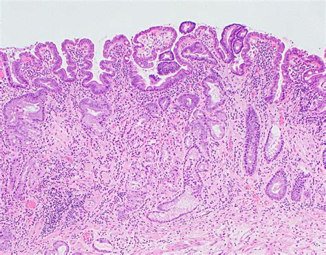 Meckel Diverticulum