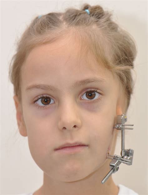 Craniofacial (Hemifacial) Microsomia | Hellenic Craniofacial Center