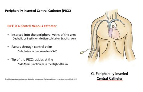 Picc In Innominate Vein