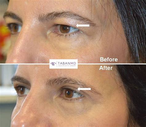 Upper Blepharoplasty Beverly Hills | Eyelid Lift Los Angeles