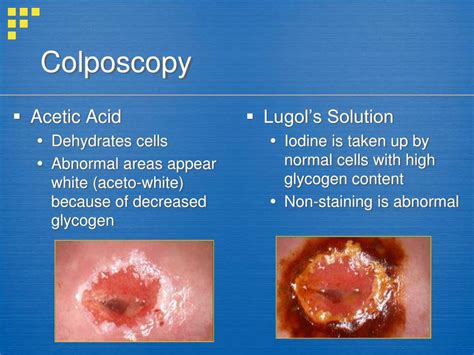 PPT - Management of Abnormal Pap Smears and Cervical Dysplasia PowerPoint Presentation - ID:1172135