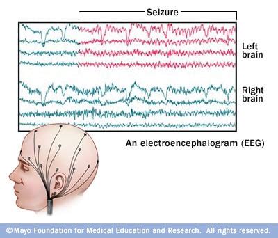 Epilepsy - Diagnosis - Mayo Clinic