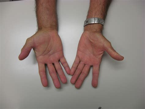 Infection: Radical flexor synovectomy hand and forearm for granulomatous synovitis