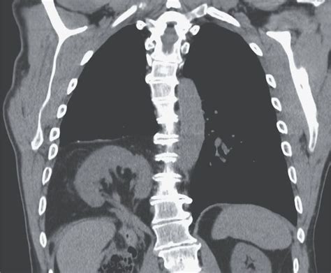 Ectopic Kidney - MEDizzy