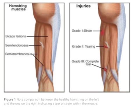 Hamstring Tear - Sports Clinic NQ