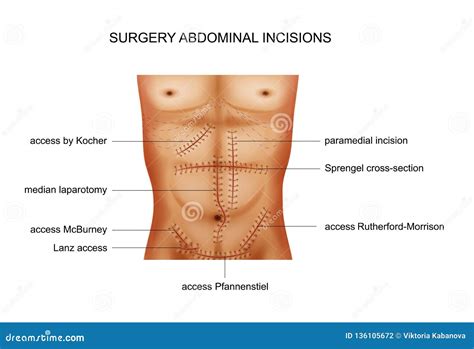 Incision Cartoons, Illustrations & Vector Stock Images - 3553 Pictures ...