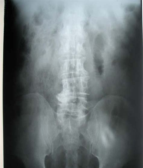 Phytobezoar in a jejunal diverticulum as a cause of small bowel obstruction: a case report ...