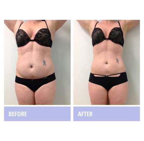 Get Rid of Stubborn Fat with Non-Invasive, Body Contouring Zerona Laser!