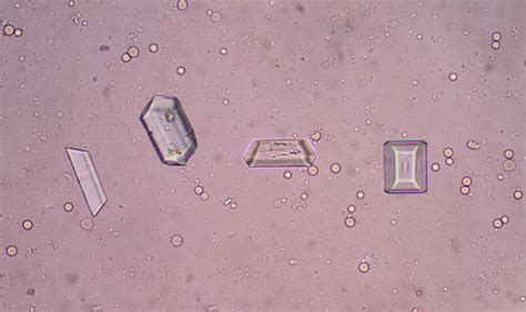 Triple Phosphate Crystal In Urine Sediment Stock Photo - Download Image Now - iStock