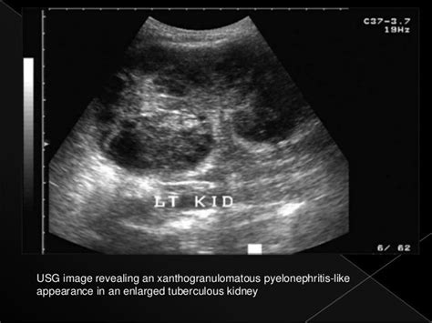 Renal tuberculosis radiology