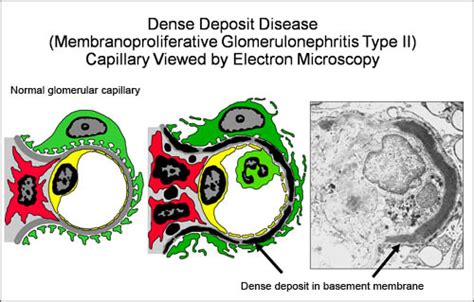 Membranoproliferative Glomerulonephritis – NephCure Kidney International