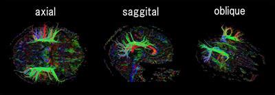 Frontiers | Detection and Growth Pattern of Arcuate Fasciculus from ...