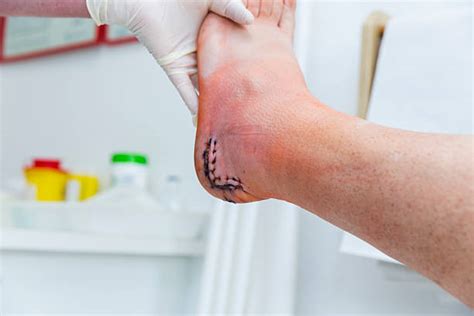 30+ Surgical Scar From Achilles Tendon Injury Stock Photos, Pictures ...