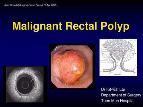 PPT - Malignant Rectal Polyp PowerPoint Presentation, free download ...