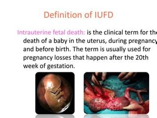 Intrauterine Fetal Death (IUFD),(Kurdistan)