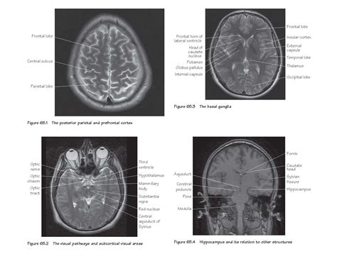 Neuroradiological Anatomy - pediagenosis