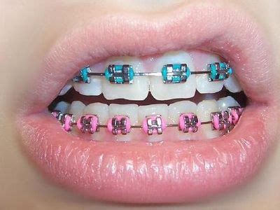 braces tumblr - Google Search Braces Teeth Colors, Cute Braces Colors, Teeth Braces, Braces Food ...