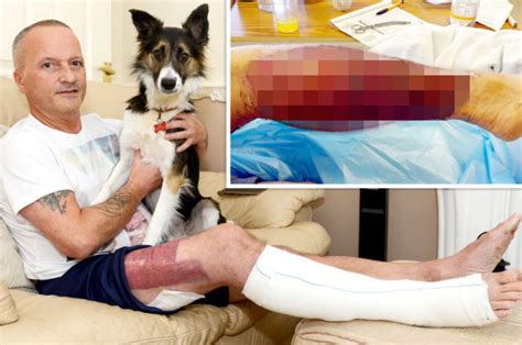 White phosphorus abandoned on beach leaves man with horrific burns ...