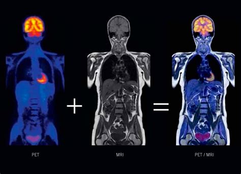 How do PET scans differ from MRI scans for neuroendocrine cancer ...