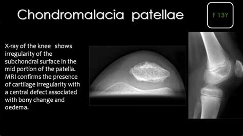 Pin by Dr abuaiad on bone and joints | Mri brain, Bone and joint, Chondromalacia patellae