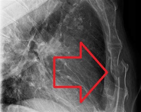 Sternum fracture – diagnosis, treatment – Healthy Food Near Me