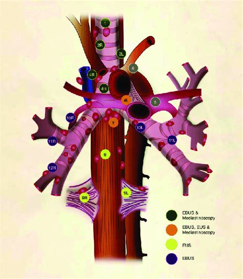 Lymph node map adapted from the 2009 IASLC lung cancer staging project ...