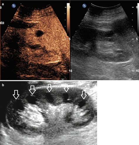 Cystic Diseases of the Kidney | Abdominal Key