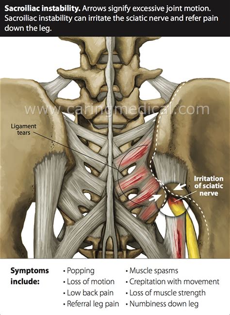 Prolotherapy in patients with sacroiliac joint instability - GetProlo.com