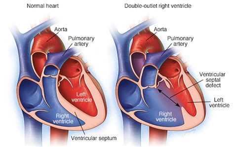 Double Outlet Right Ventricle - Repair, Surgery & Survival Rate