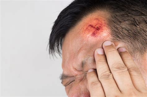 i hit my head how do i know if it is serious | Injured Call Today