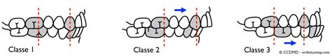 classification malocclusion angle diagramme orthodontie sherbrooke