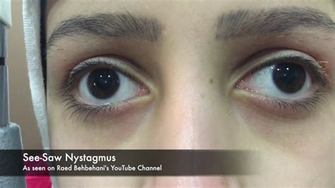 Reel-Example: See-Saw Nystagmus - YouTube