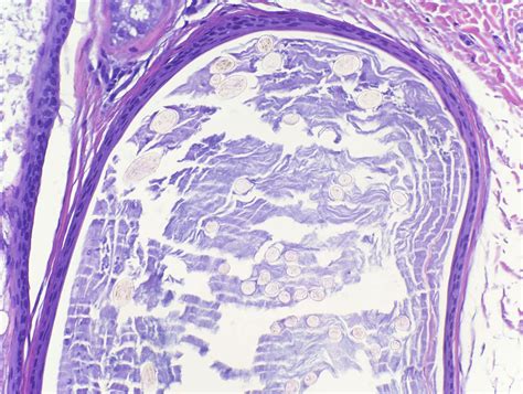 VIRTUAL GRAND ROUNDS IN DERMATOLOGY 2.0: Vellus Hair Cysts