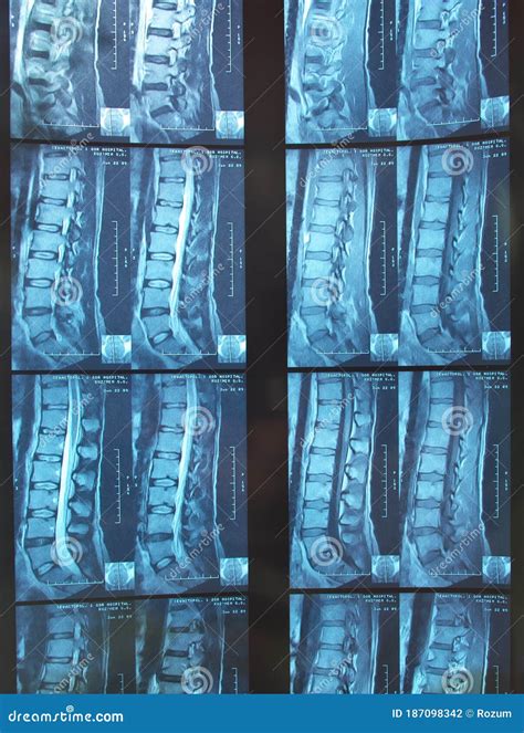 X-ray Image of a Human Adult Backbone Stock Photo - Image of doctor, hospital: 187098342