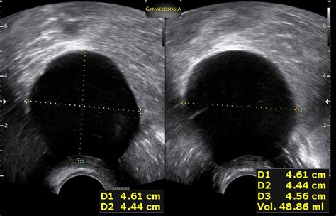 varying-echogenicity-1 – Gynaecologia