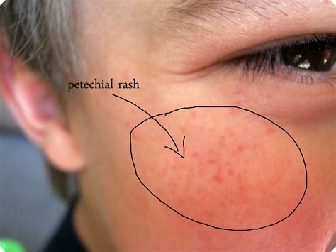 STITCH by Fay: Ever Wondered What A Meningitis Rash Looks Like?!