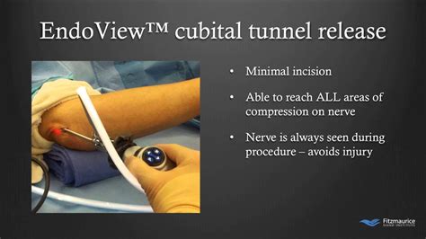 Radial Tunnel Syndrome