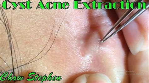 Cyst Acne Removed Behind The Ear - Chow Stephen | Cyst acne, Acne extraction, Acne