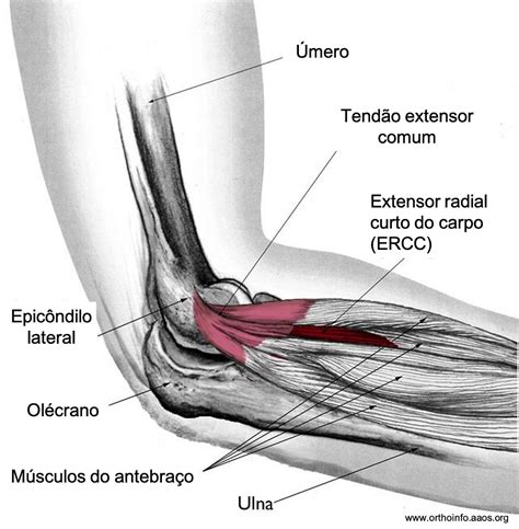 Epicondilite lateral do cotovelo ("tennis elbow") | Dr Fernando Brandão