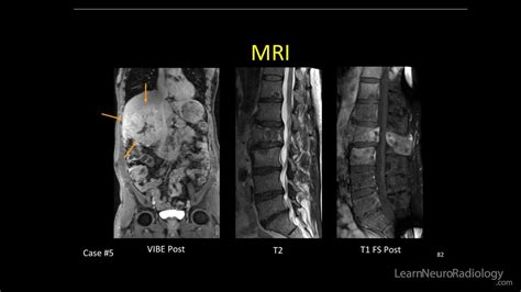 How Common Are Ms Thoracic Spine Lesions? Trust The Answer - Chiangmaiplaces.net