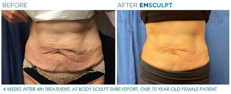 EMSCULPT® Results at Body Sculpt Shreveport