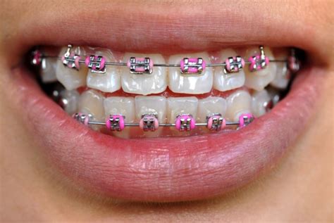 How to Choose Colors for Braces | Nutley Braces | Ollins Orthodontics