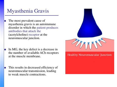 PPT - Myasthenia Gravis: A Neurologist’s Perspective PowerPoint ...