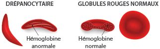 Drépanocytose | Fil santé jeunes