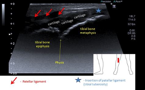 Normal Knee Ultrasound